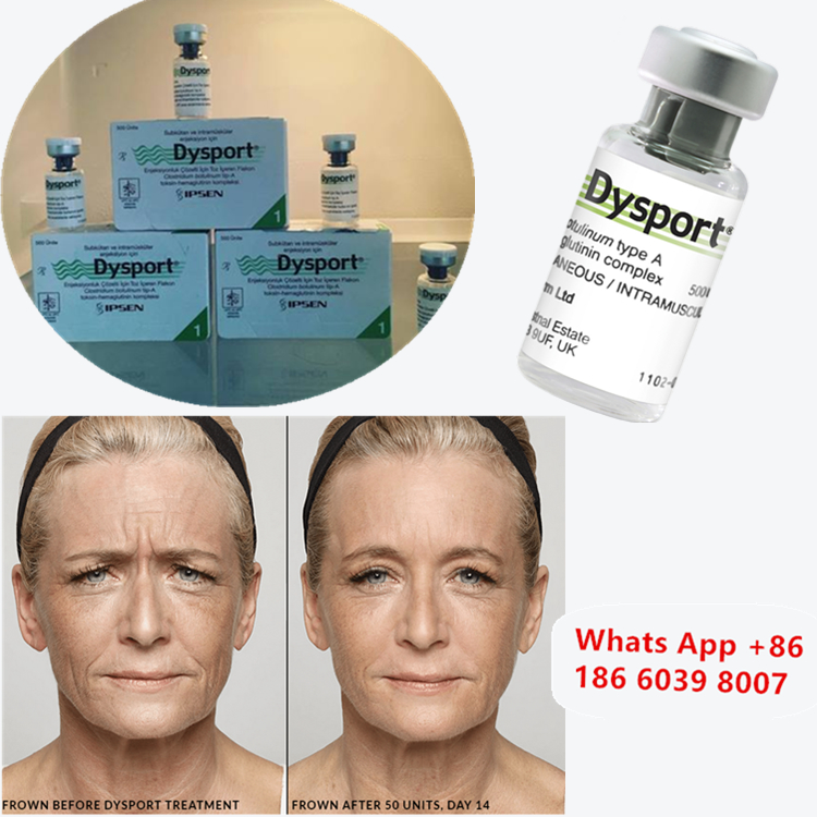 Dysport 500u Botulinum Toksin Tip A Yanak İyileştirme İçin