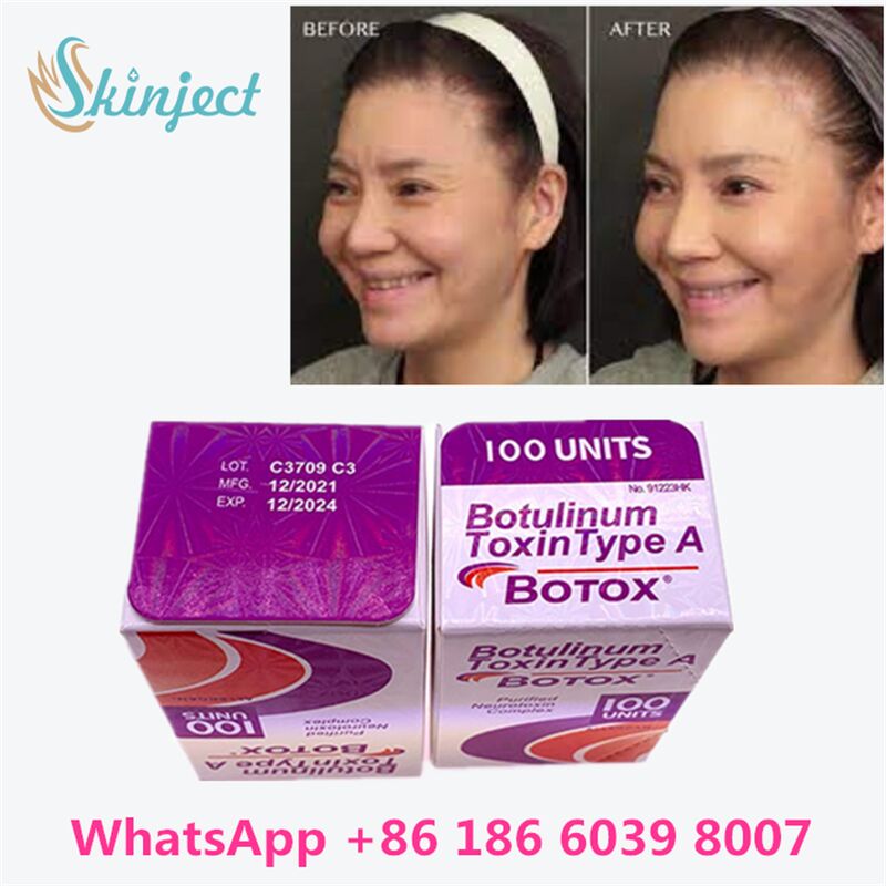 Allergan Botox Botulinum Toxin Tip A kırışıklığı kaldırmak için 100 birim 4 ~ 6 ay süren