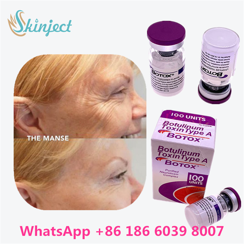 Botulinum Toksin BOTOX Kozmetik 100 Birim Alerjan Onabotulinum ToksinA Yüz kırışıklıkları için
