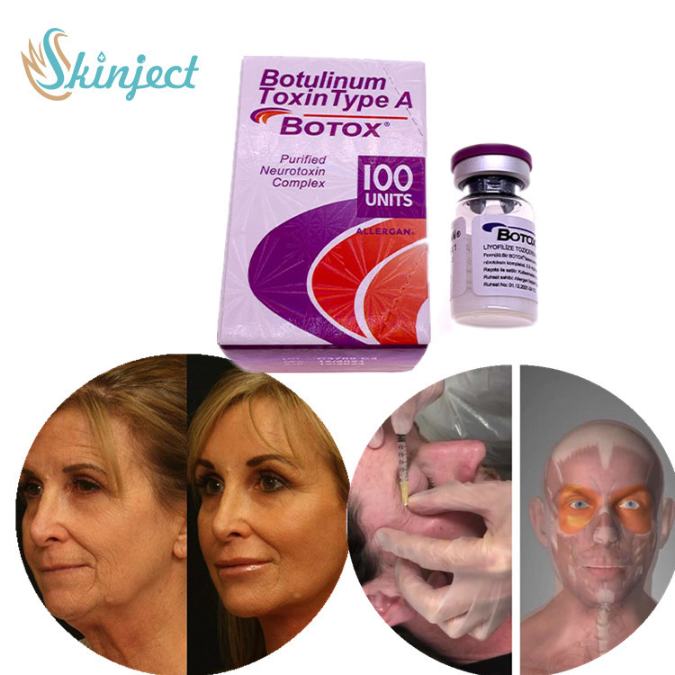 Yüz Botulinum Toksini Tip A Enjeksiyonu Kırışıklık Giderme