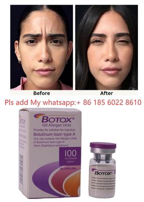 ALLERGAN Botox Enjeksiyonu Botulinum Toksin Tip A